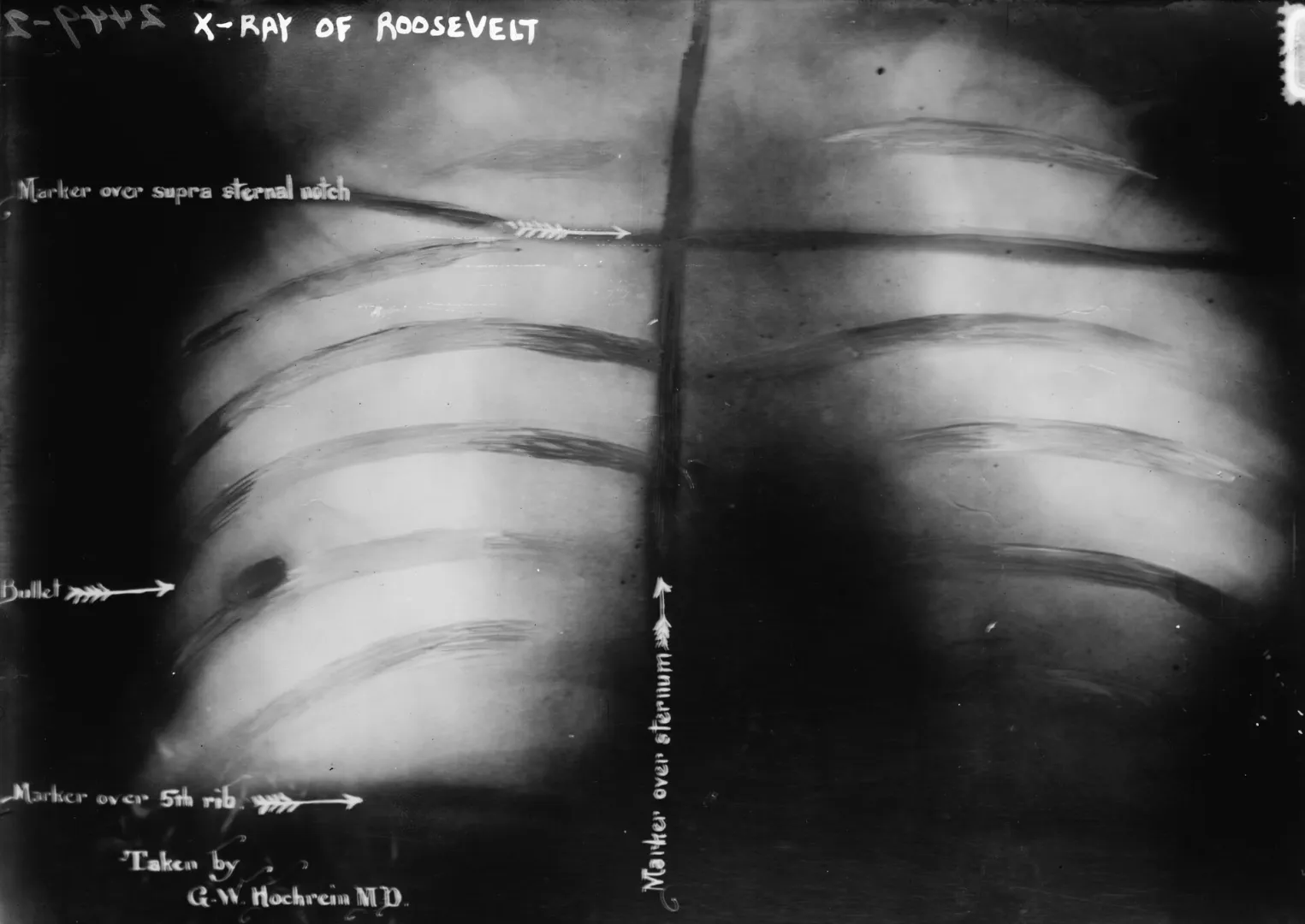 The X-ray showing the bullet lodged in Roosevelt's chest